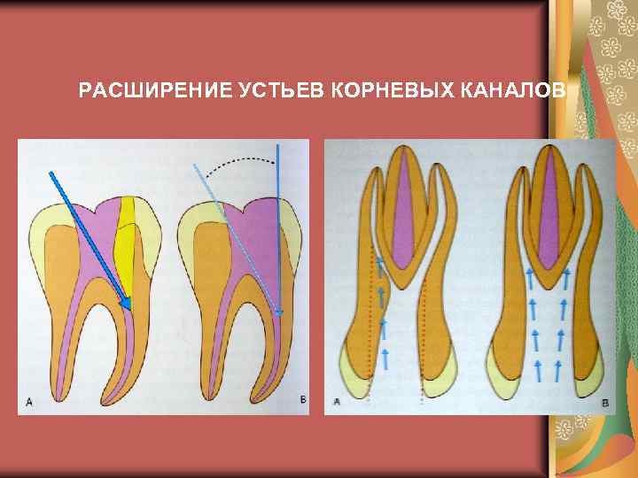 Трети корневого канала. Расширение устья корневого канала. Устье корневого канала зуба. Расширение устьевой части корневого канала.