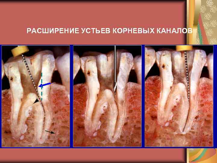 РАСШИРЕНИЕ УСТЬЕВ КОРНЕВЫХ КАНАЛОВ 