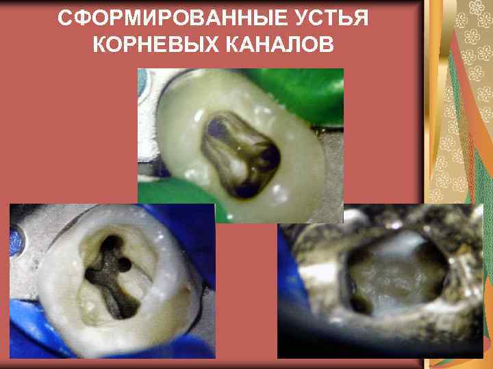 СФОРМИРОВАННЫЕ УСТЬЯ КОРНЕВЫХ КАНАЛОВ 