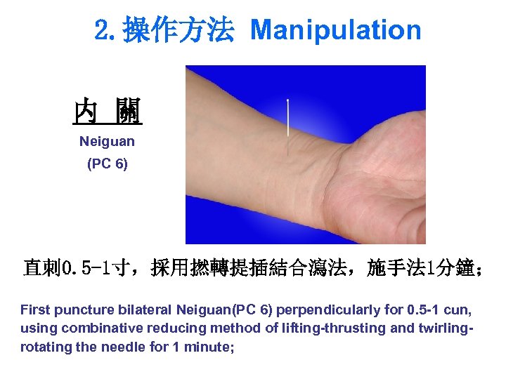 2. 操作方法 Manipulation 内 關 Neiguan (PC 6) 直刺 0. 5 -1寸，採用撚轉提插結合瀉法，施手法 1分鐘； First