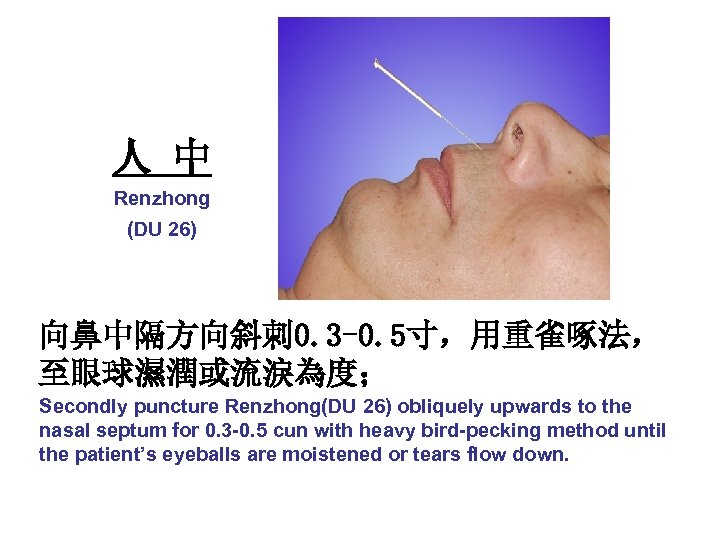 人 中 Renzhong (DU 26) 向鼻中隔方向斜刺 0. 3 -0. 5寸，用重雀啄法， 至眼球濕潤或流淚為度； Secondly puncture Renzhong(DU