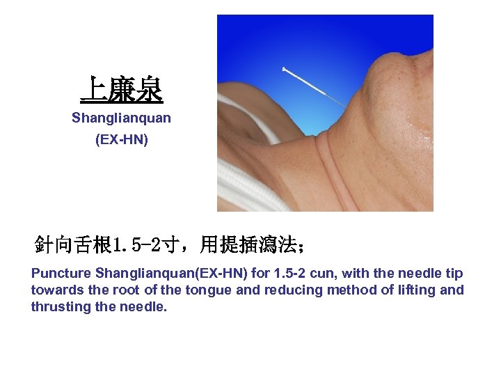 上廉泉 Shanglianquan (EX-HN) 針向舌根 1. 5 -2寸，用提插瀉法； Puncture Shanglianquan(EX-HN) for 1. 5 -2 cun,