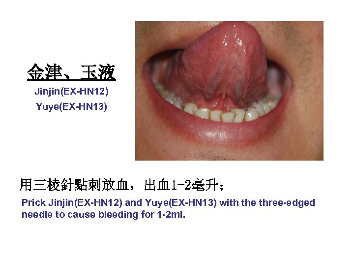 金津、玉液 Jinjin(EX-HN 12) Yuye(EX-HN 13) 用三棱針點刺放血，出血1 -2毫升； Prick Jinjin(EX-HN 12) and Yuye(EX-HN 13) with