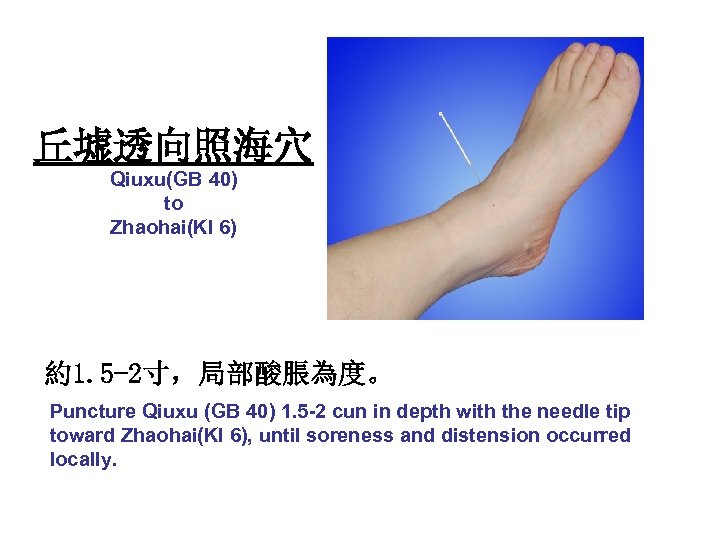 丘墟透向照海穴 Qiuxu(GB 40) to Zhaohai(KI 6) 約1. 5 -2寸，局部酸脹為度。 Puncture Qiuxu (GB 40) 1.