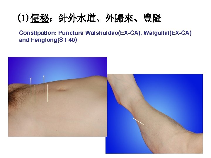 (1)便秘：針外水道、外歸來、豐隆 Constipation: Puncture Waishuidao(EX-CA), Waiguilai(EX-CA) and Fenglong(ST 40) 