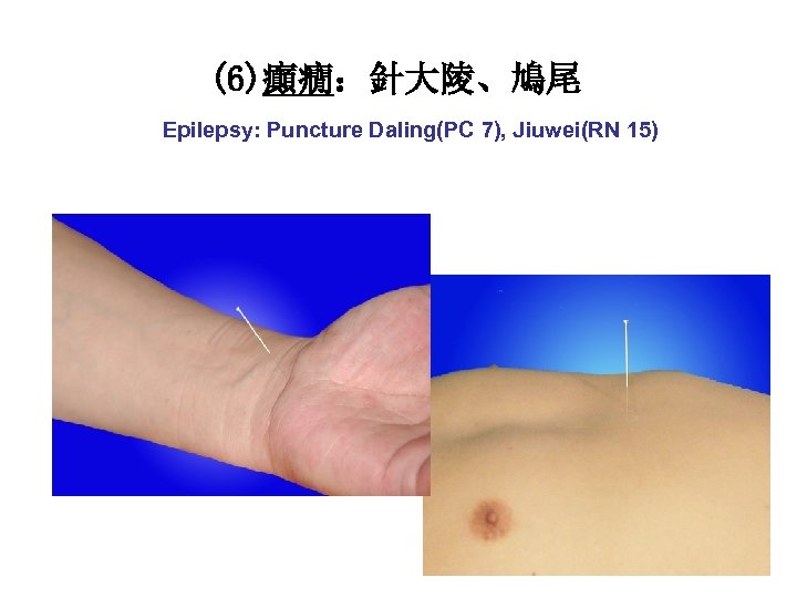 (6)癲癇：針大陵、鳩尾 Epilepsy: Puncture Daling(PC 7), Jiuwei(RN 15) 