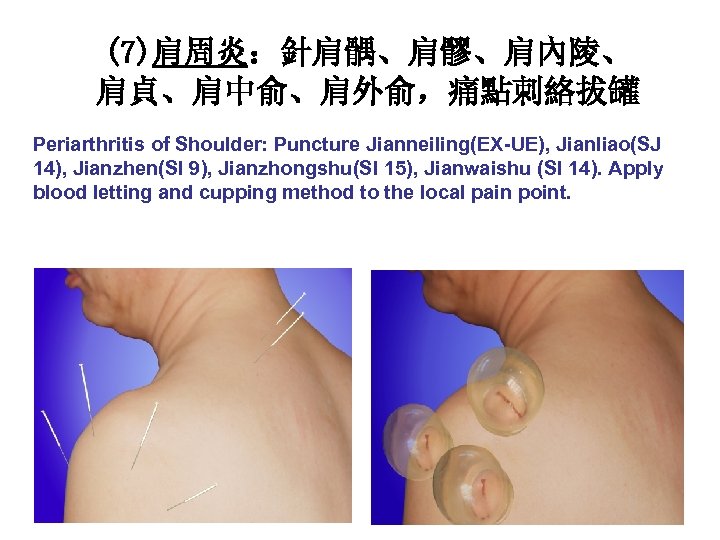 (7)肩周炎：針肩髃、肩髎、肩內陵、 肩貞、肩中俞、肩外俞，痛點刺絡拔罐 Periarthritis of Shoulder: Puncture Jianneiling(EX-UE), Jianliao(SJ 14), Jianzhen(SI 9), Jianzhongshu(SI 15), Jianwaishu