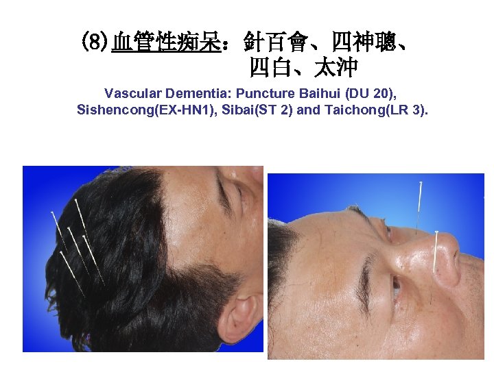 (8)血管性痴呆：針百會、四神聰、 四白、太沖 Vascular Dementia: Puncture Baihui (DU 20), Sishencong(EX-HN 1), Sibai(ST 2) and Taichong(LR