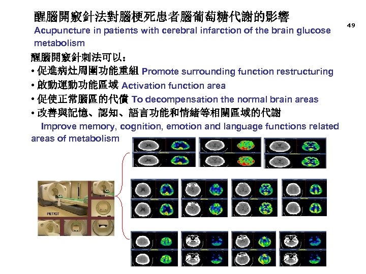 醒腦開竅針法對腦梗死患者腦葡萄糖代謝的影響 Acupuncture in patients with cerebral infarction of the brain glucose metabolism 醒腦開竅針刺法可以： •