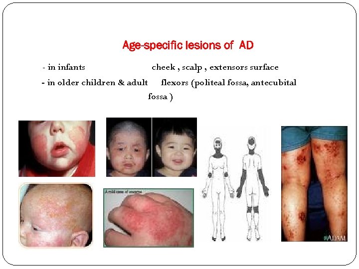 Age-specific lesions of AD - in infants - in older children & adult cheek