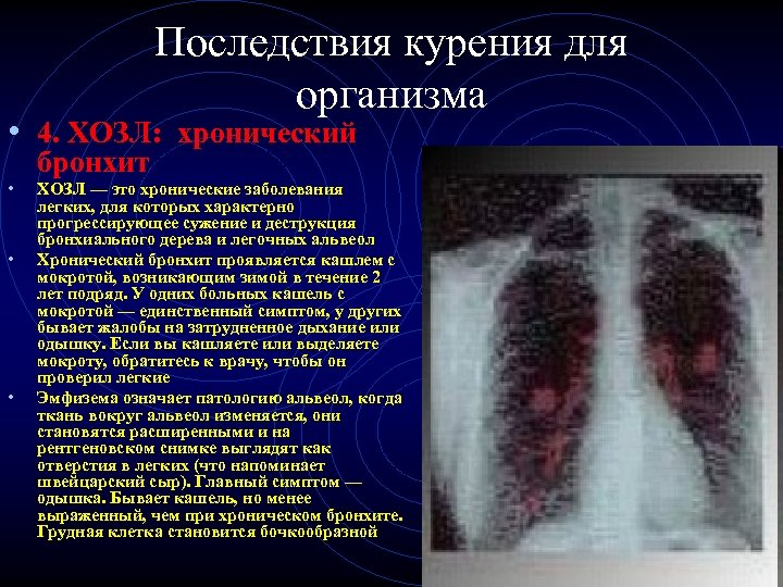 Последствия курения для организма • 4. ХОЗЛ: хронический • • • бронхит ХОЗЛ —