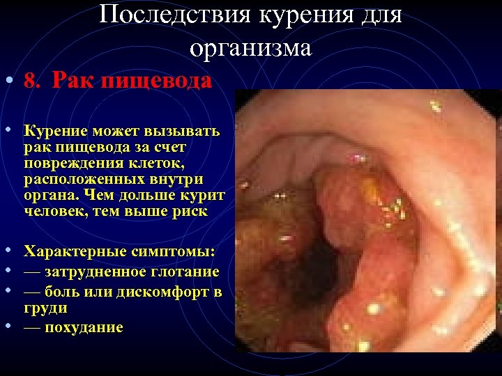 Последствия курения для организма • 8. Рак пищевода • Курение может вызывать рак пищевода