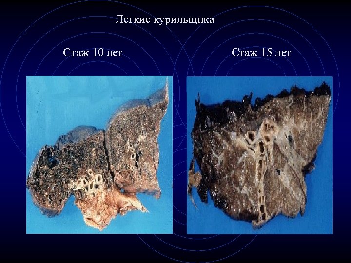 Легкие курильщика Стаж 10 лет Стаж 15 лет 