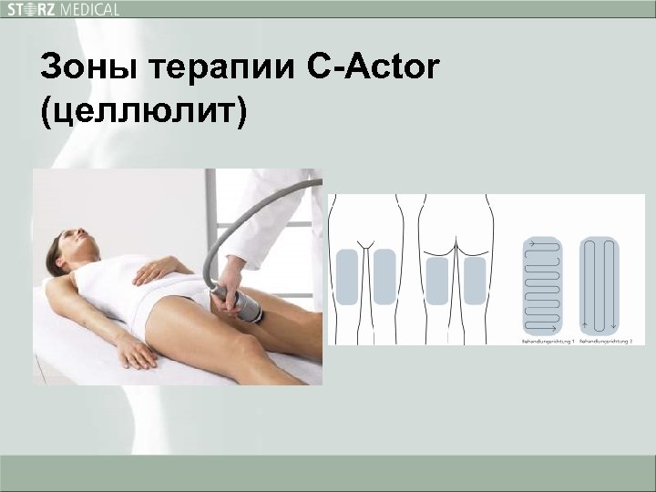 Зоны терапии С-Actor (целлюлит) 