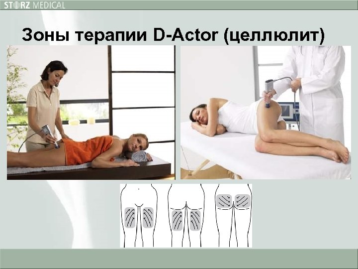 Зоны терапии D-Actor (целлюлит) 