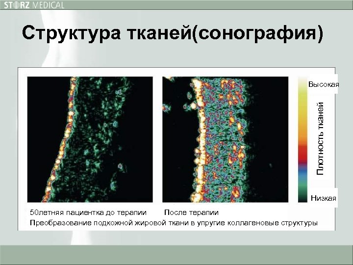 Структура тканей(сонография) Плотность тканей Высокая Низкая 50 летняя пациентка до терапии После терапии Преобразование