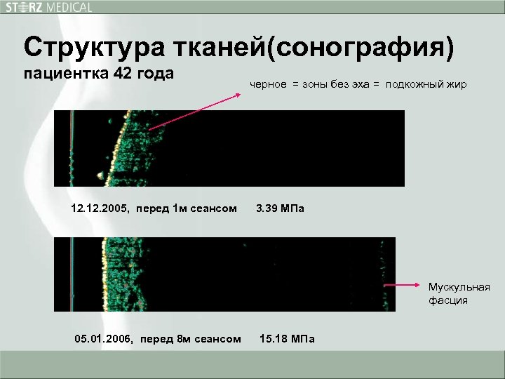 Структура тканей(сонография) пациентка 42 года 12. 2005, перед 1 м сеансом черное = зоны