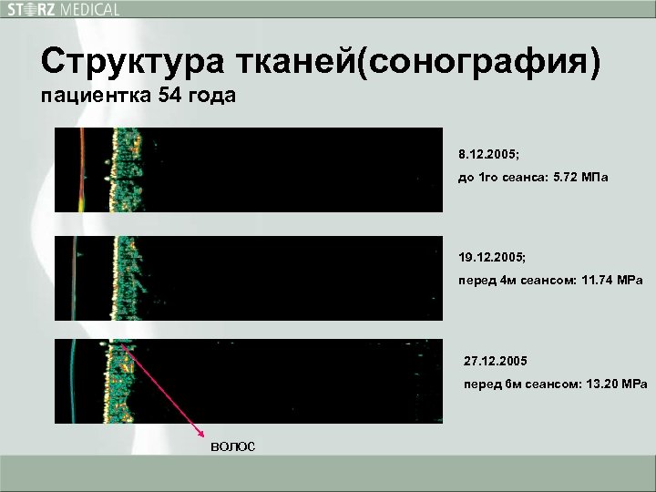 Структура тканей(сонография) пациентка 54 года 8. 12. 2005; до 1 го сеанса: 5. 72