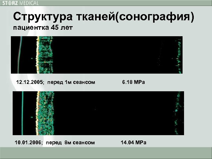 Структура тканей(сонография) пациентка 45 лет 12. 2005; перед 1 м сеансом 6. 18 MPa