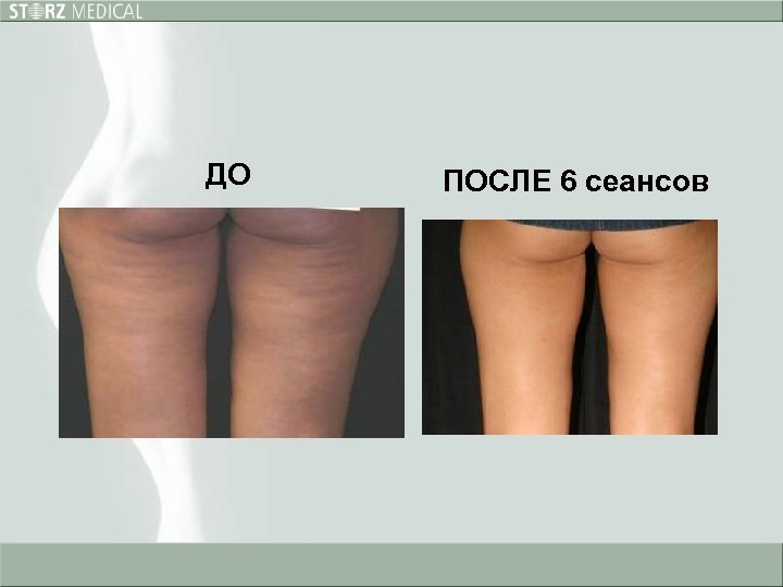 ДО ПОСЛЕ 6 сеансов 