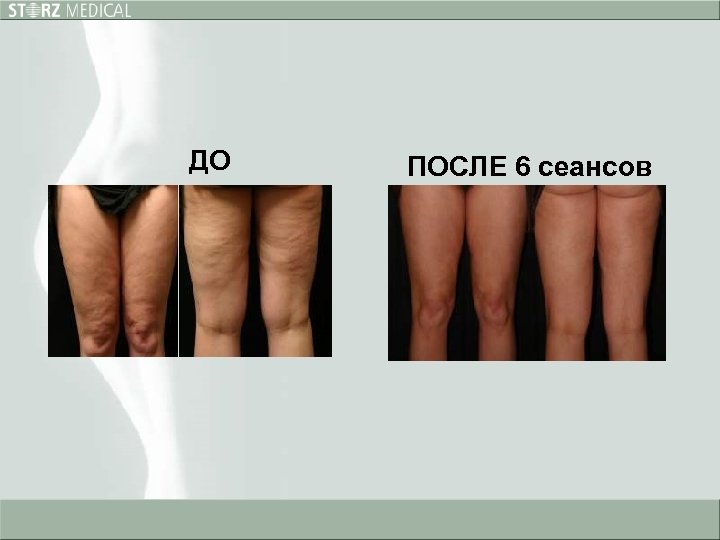 ДО ПОСЛЕ 6 сеансов 