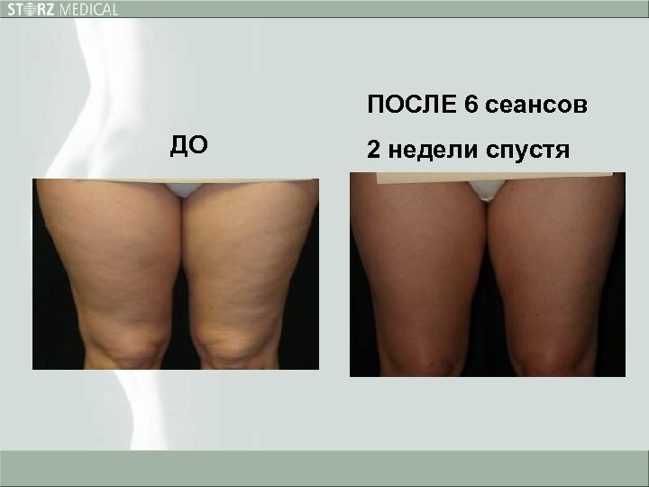 ПОСЛЕ 6 сеансов ДО 2 недели спустя 