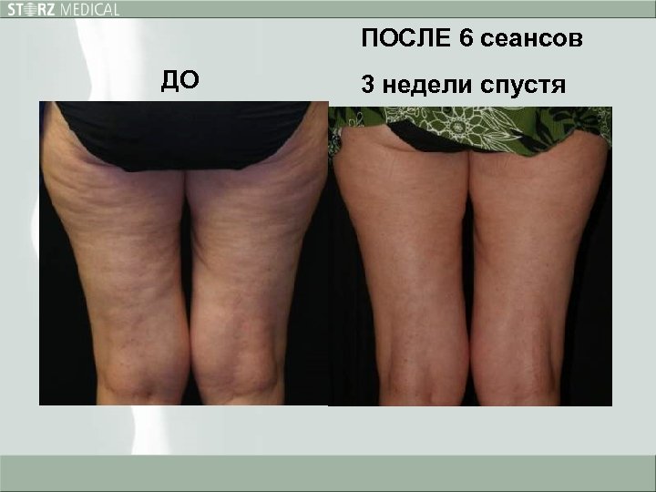 ПОСЛЕ 6 сеансов ДО 3 недели спустя 2 weeks post 6 th treatment 