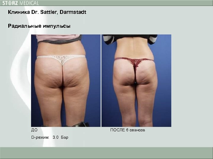 Клиника Dr. Sattler, Darmstadt Радиальные импульсы ДО D-режим: 3. 0 Бар ПОСЛЕ 6 сеансов