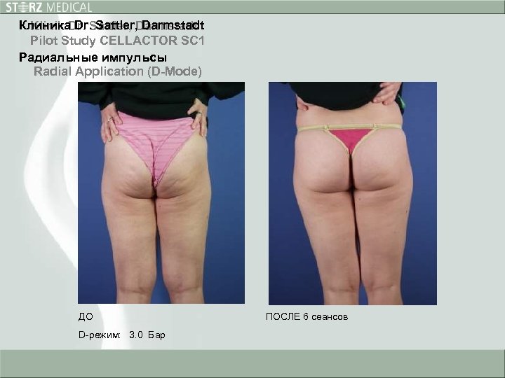 Клиника Dr. Sattler, Darmstadt Klinik Dr. Sattler, Darmstadt Pilot Study CELLACTOR SC 1 Радиальные