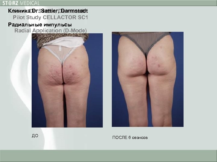 Клиника Dr. Sattler, Darmstadt Klinik Dr. Sattler, Darmstadt Pilot Study CELLACTOR SC 1 Радиальные