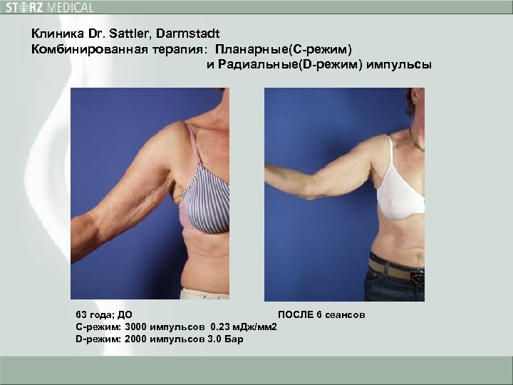 Клиника Dr. Sattler, Darmstadt Комбинированная терапия: Планарные(C-режим) и Радиальные(D-режим) импульсы 63 года; ДО ПОСЛЕ