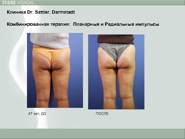 Клиника Dr. Sattler, Darmstadt Комбинированная терапия: Планарные и Радиальные импульсы 47 лет; ДО ПОСЛЕ
