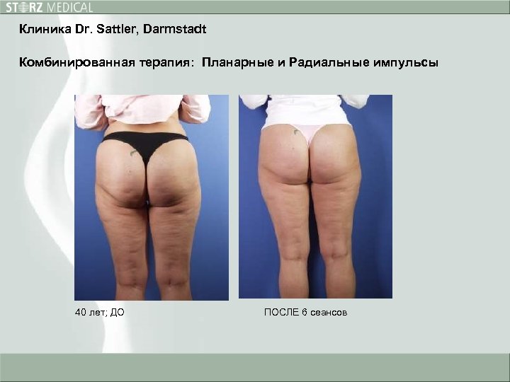 Клиника Dr. Sattler, Darmstadt Комбинированная терапия: Планарные и Радиальные импульсы 40 лет; ДО ПОСЛЕ