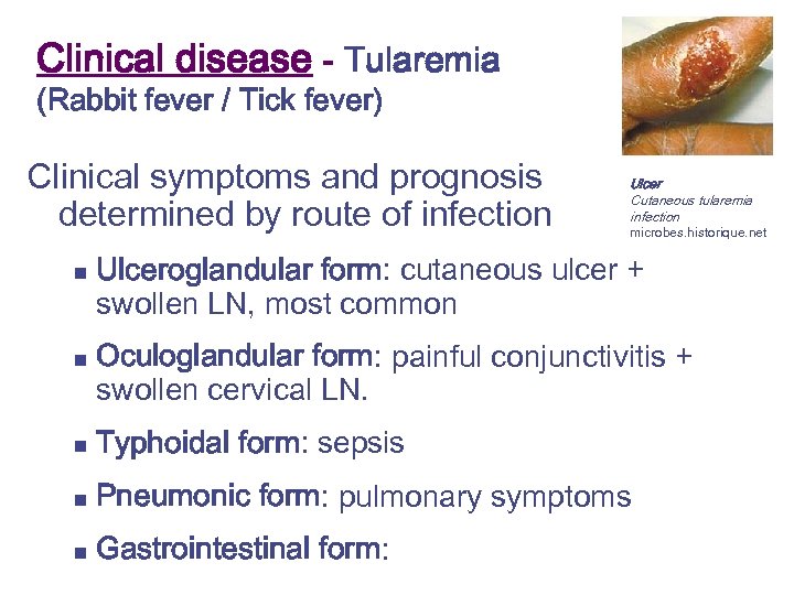 Clinical disease - Tularemia (Rabbit fever / Tick fever) Clinical symptoms and prognosis determined