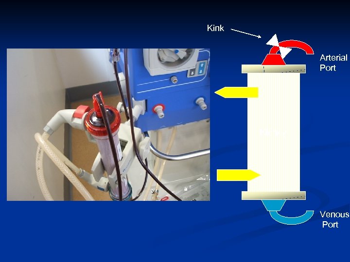 Kink Arterial Port Kidney Venous Port 