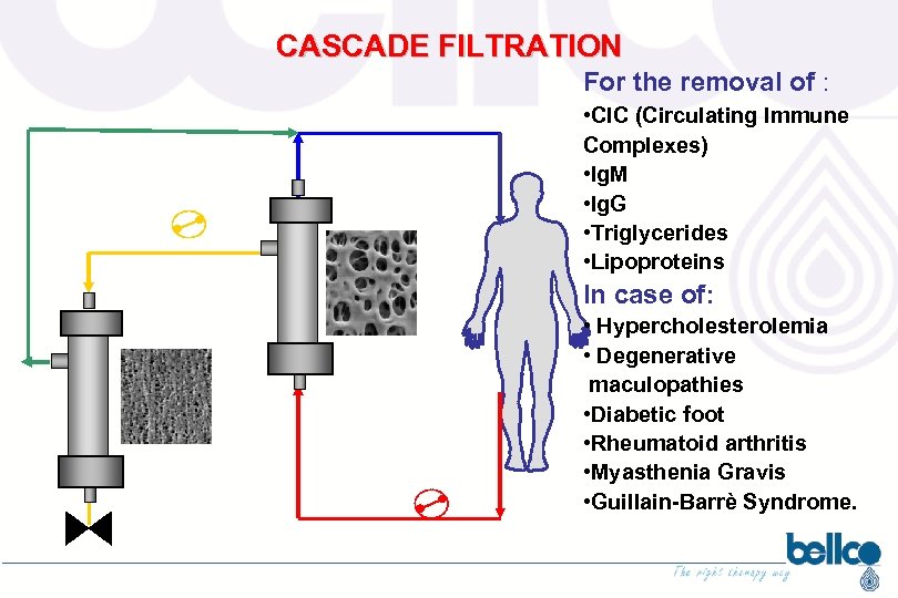 CASCADE FILTRATION For the removal of : PLASMAFILTRO • CIC (Circulating Immune Complexes) •