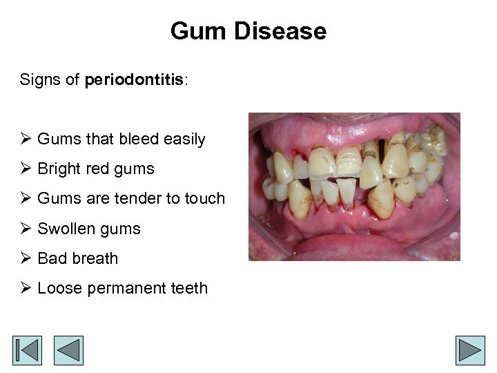 Gum Disease Signs of periodontitis: Ø Gums that bleed easily Ø Bright red gums