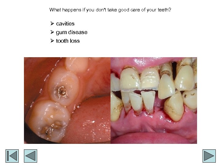 What happens if you don't take good care of your teeth? Ø cavities Ø