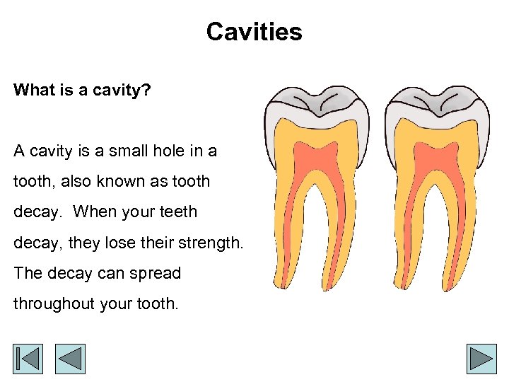 Cavities What is a cavity? A cavity is a small hole in a tooth,