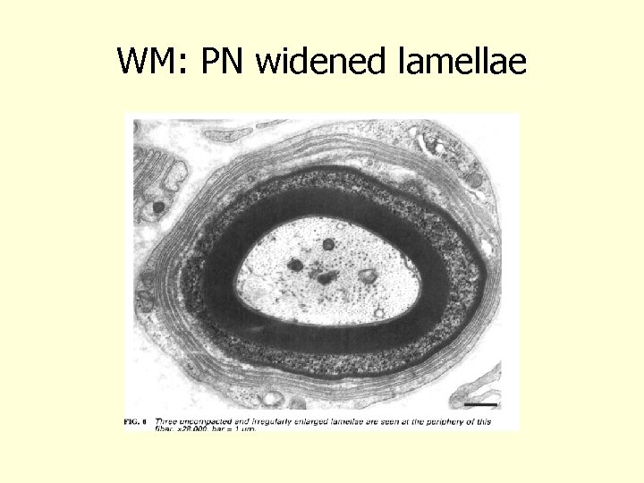 WM: PN widened lamellae Vital 1997 