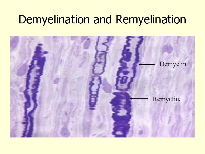 Demyelination and Remyelination Demyelin Remyelin. 