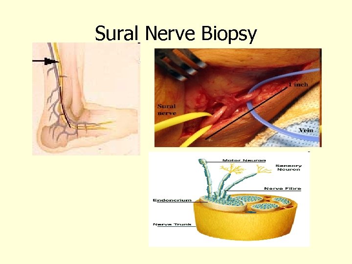 Sural Nerve Biopsy 
