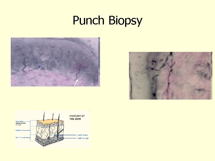 Punch Biopsy 