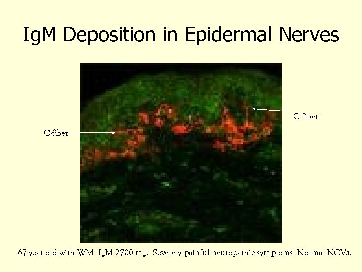 Ig. M Deposition in Epidermal Nerves C fiber C-fiber 67 year old with WM.