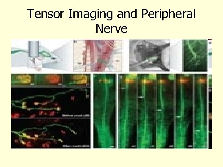 Tensor Imaging and Peripheral Nerve 