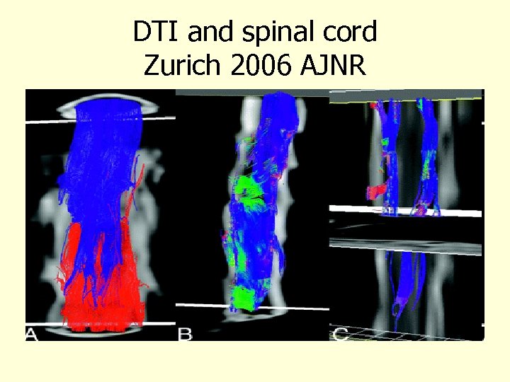 DTI and spinal cord Zurich 2006 AJNR 