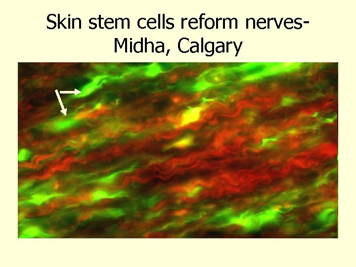 Skin stem cells reform nerves. Midha, Calgary 
