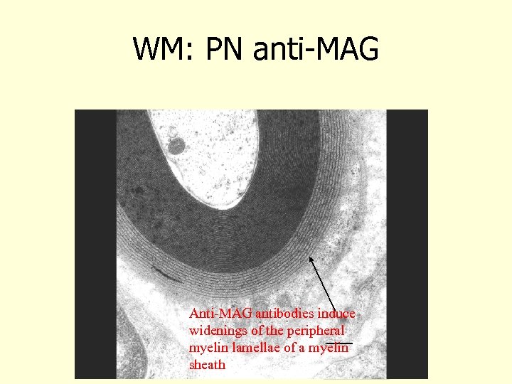 WM: PN anti-MAG Anti-MAG antibodies induce widenings of the peripheral myelin lamellae of a