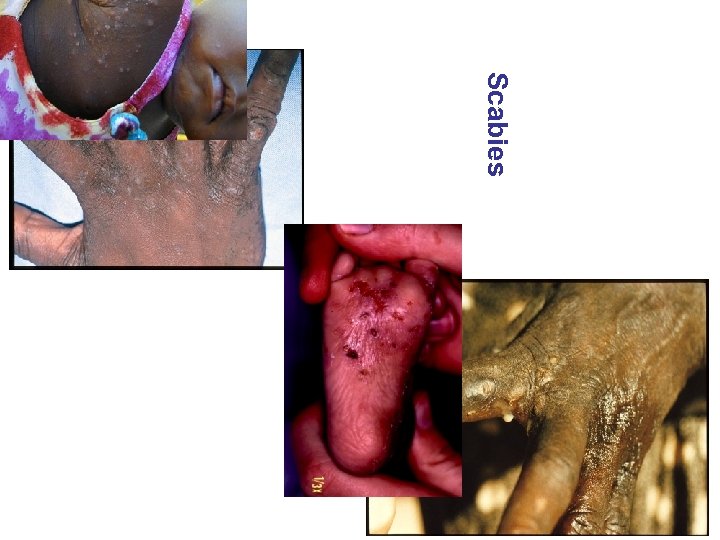 Scabies 