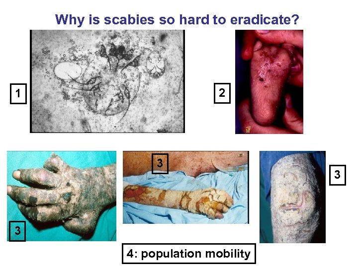 Why is scabies so hard to eradicate? 2 1 3 3 4: population mobility